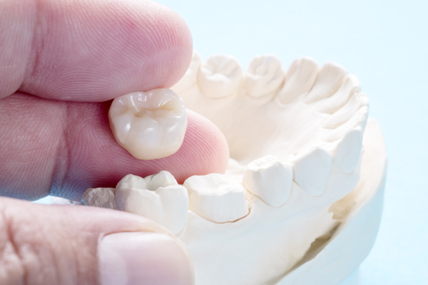 How Many Appointments Are Needed To Get A Dental Crown?