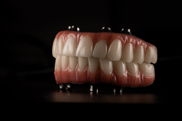 Implant Supported Dentures: Can They Successfully Replace Upper Teeth?